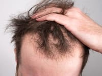 Hair Loss Treatments